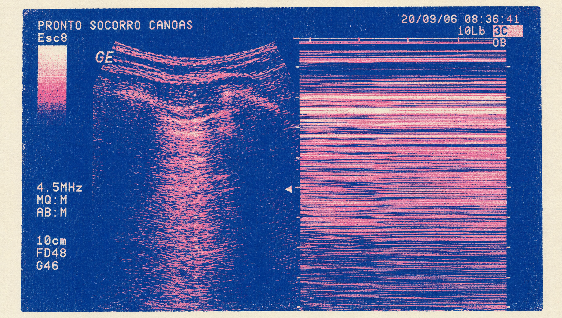 picture of lung ultrasound image